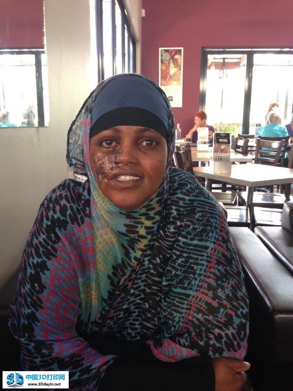 ayaan-3d-printed-face-1