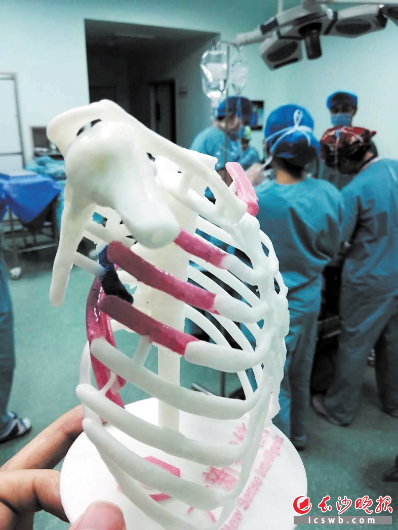 手术中使用的3D模型。长沙晚报通讯员 申勇 摄