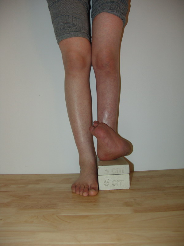 足踝关节畸形 足踝关节畸形