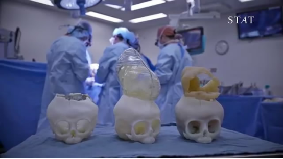 3D打印立功!这个头骨模型挽救了婴儿的生命
