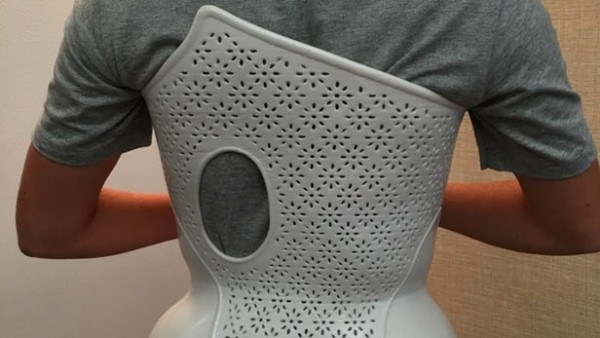 [图]意大利医生利用3D打印技术制作出更好的矫正束身衣