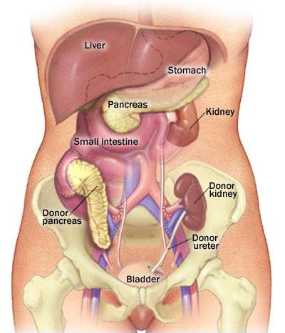 宾汉普顿大学尝试为1型糖尿病患者生物3D打印胰腺