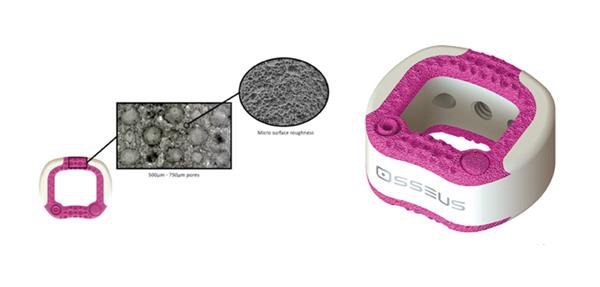 Osseus的3D打印脊柱颈段植入物获FDA批准