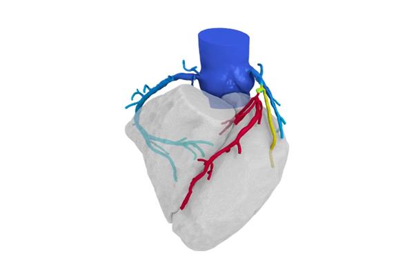 HeartFlow筹集2.4亿美元用于商业化3D打印心脏模型诊断技术 HeartFlow筹集2.4亿美元用于商业化3D打印心脏模型诊断技术