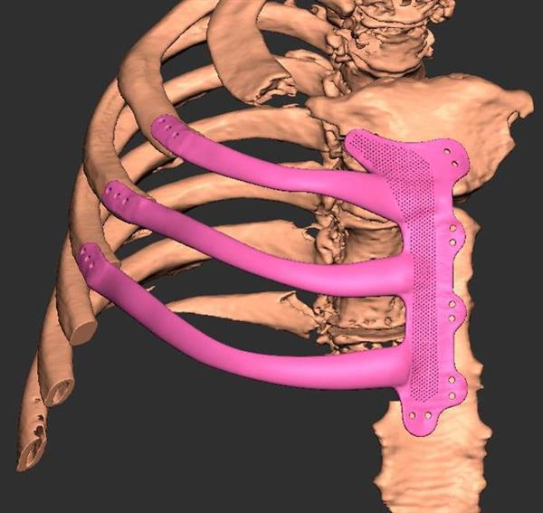 3D打印胸部假体有助于威尔士男子从巨大肿瘤中康复 3D打印胸部假体有助于威尔士男子从巨大肿瘤中康复