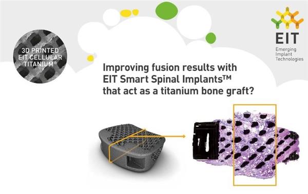 强生收购3D打印脊柱植入物制造商Emerging Implant Technologies 强生收购3D打印脊柱植入物制造商Emerging Implant Technologies
