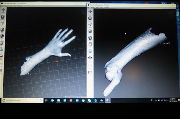 约旦安曼无国界医生中东冲突受害者提供3D打印假肢 约旦安曼无国界医生中东冲突受害者提供3D打印假肢