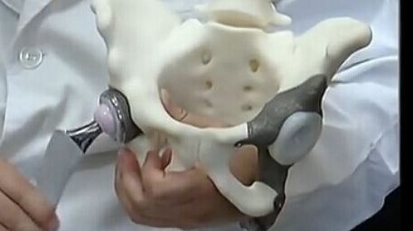 3D打印技术在人工髋关节置换术中的应用现状及前景 3D打印技术在人工髋关节置换术中的应用现状及前景