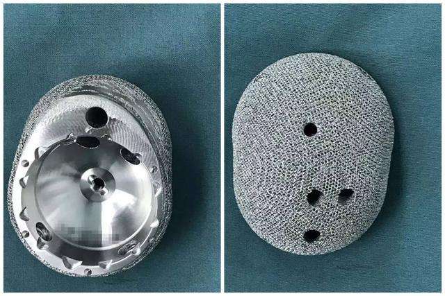 3D打印技术在人工髋关节置换术中的应用现状及前景 3D打印技术在人工髋关节置换术中的应用现状及前景