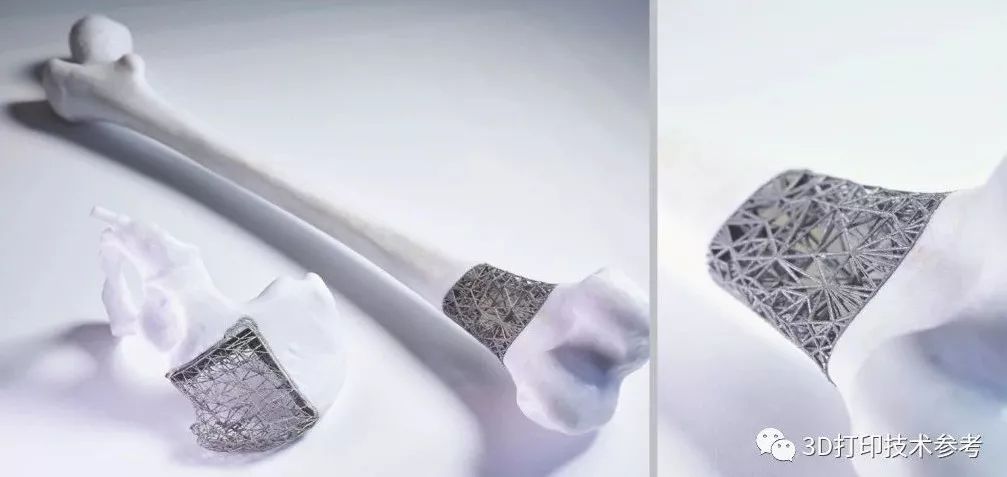 医疗:PEEK相较金属植入物的优势与不足 医疗:PEEK相较金属植入物的优势与不足