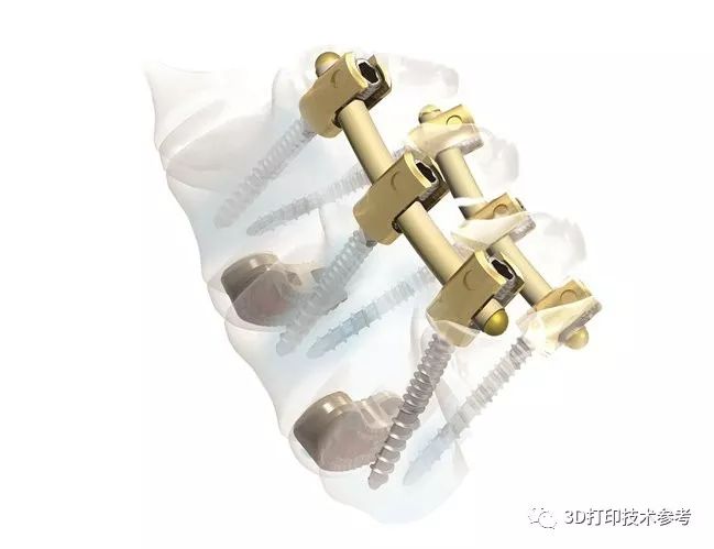医疗:PEEK相较金属植入物的优势与不足 医疗:PEEK相较金属植入物的优势与不足