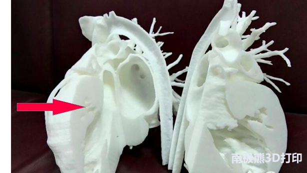 澳大利亞首例：醫(yī)生用3D打印技術(shù)進(jìn)行心臟手術(shù)