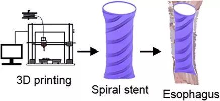 佛罗里达大西洋大学：3D打印柔性自扩张支架，治疗食道癌患者