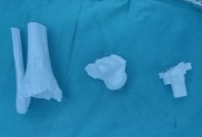 达到国内先进水平！青岛这家医院用3D打印技术，完成一例全踝关节置换术