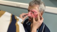英国NHS新3D打印中心成功为一名75岁自行车手修复严重缺损面部