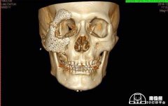 <b>盘点已将3D打印用于临床手术的国内医院</b> <b>盘点已将3D打印用于临床手术的国内医院</b>