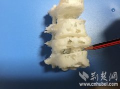 <b>宜昌首次将3D打印技术应用于复杂高危脊柱手术</b> <b>宜昌首次将3D打印技术应用于复杂高危脊柱手术</b>
