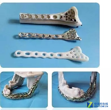 TCT亚洲展:3D打印在骨板设计中的应用