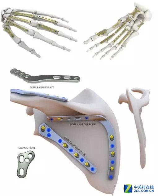 TCT亚洲展:3D打印在骨板设计中的应用