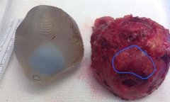 <b>伦敦医生借助3D打印成功切除前列腺肿瘤</b> <b>伦敦医生借助3D打印成功切除前列腺肿瘤</b>