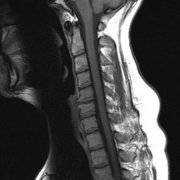 <b>Stryker��˾3D��ӡ�ѽ�����·��׵���̻�FDA��׼</b>