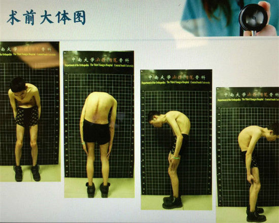 男子脊柱弯曲110度 3D打印助其挺直腰杆