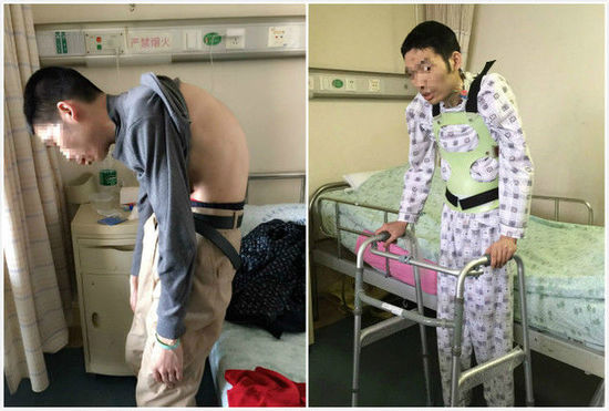 男子脊柱弯曲110度 3D打印助其挺直腰杆