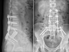 <b>清华长庚完成世界首例高位骶骨整块切除并3D打印假体重建术</b> <b>清华长庚完成世界首例高位骶骨整块切除并3D打印假体重建术</b>
