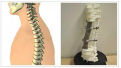 <b>世界首个3D打印定制五节长达19厘米脊椎 救治恶性脊椎肿瘤患者</b> <b>世界首个3D打印定制五节长达19厘米脊椎 救治恶性脊椎肿瘤患者</b>