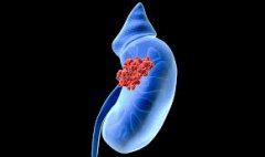 <b>美国医生利用3D打印肾脏模型成功实施肿瘤切除手术</b> <b>美国医生利用3D打印肾脏模型成功实施肿瘤切除手术</b>