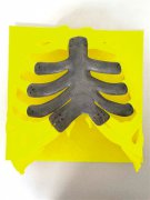 惨!患肿瘤后胸骨被切除 强!3D打印“护心镜”植入胸腔 惨!患肿瘤后胸骨被切除 强!3D打印“护心镜”植入胸腔