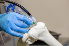 <b>溧阳人民医院应用3D打印技术治疗骨折超100例</b> <b>溧阳人民医院应用3D打印技术治疗骨折超100例</b>