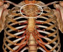 <b>第四军医大学分享个性化医疗3D打印实战案例与成果</b> <b>第四军医大学分享个性化医疗3D打印实战案例与成果</b>