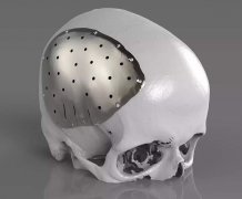 <b>颅骨植入物,从3D扫描到3D打印一站式完成</b> <b>颅骨植入物,从3D扫描到3D打印一站式完成</b>
