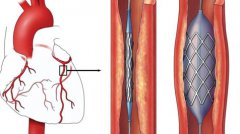 <b>科学家展示可生物降解的自扩展3D打印支架,用于小儿心脏手术</b> <b>科学家展示可生物降解的自扩展3D打印支架,用于小儿心脏手术</b>