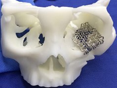 <b>湖南省郴州市第一人民医院首例“3D打印眼科手术”成功完成</b> <b>湖南省郴州市第一人民医院首例“3D打印眼科手术”成功完成</b>