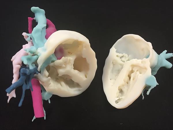 3D打印正在改变先天性心脏病的治疗方法 3D打印正在改变先天性心脏病的治疗方法