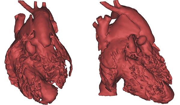 3D打印正在改变先天性心脏病的治疗方法 3D打印正在改变先天性心脏病的治疗方法