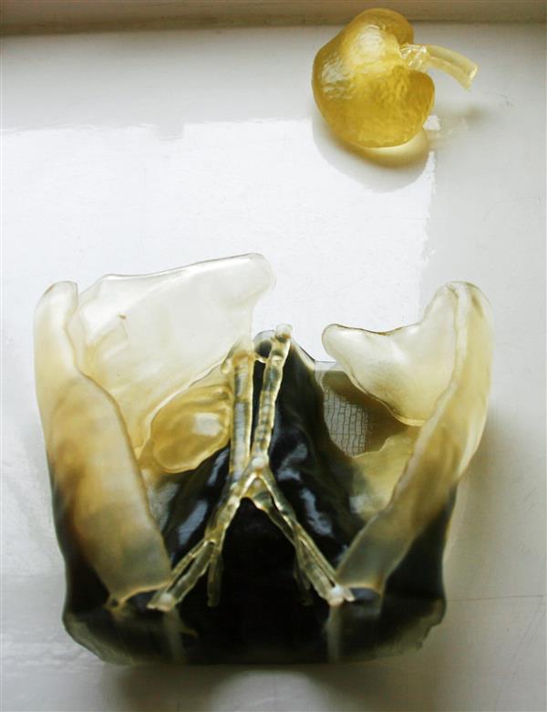 医生使用3D打印技术为2岁男孩做复杂肾脏移植手术 医生使用3D打印技术为2岁男孩做复杂肾脏移植手术