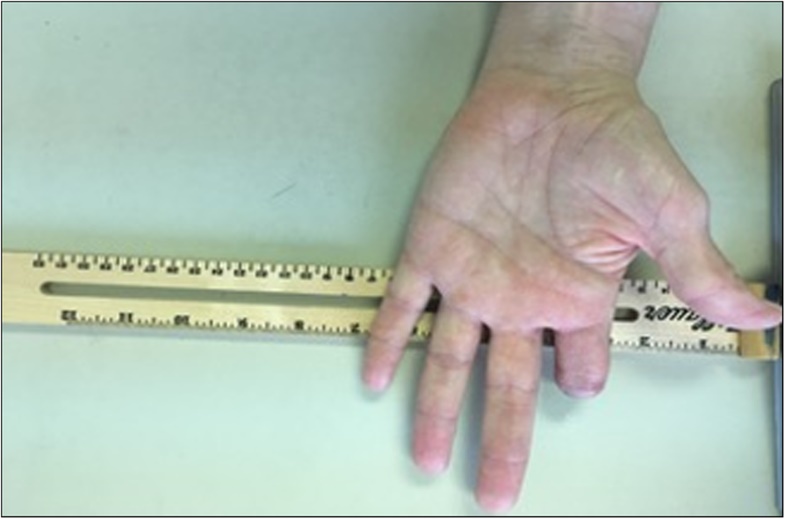 研究對像在左手近端指間關節截肢