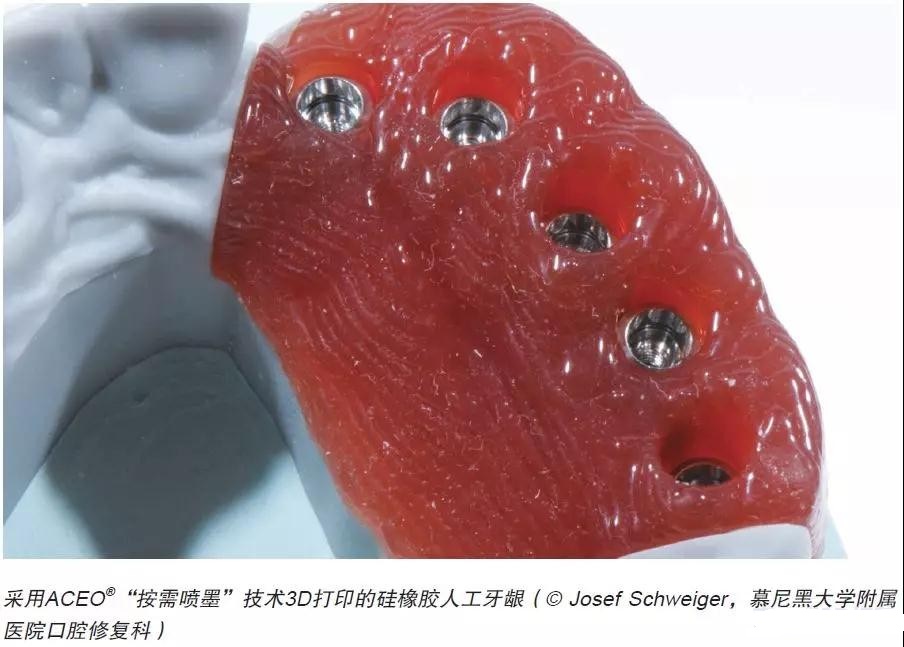 硅胶3D打印牙科应用 硅胶3D打印牙科应用