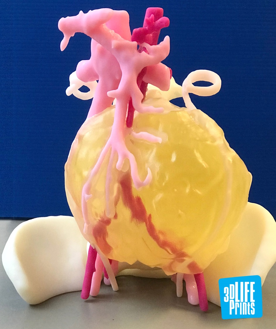 3D打印的肿瘤模型 3D打印的肿瘤模型