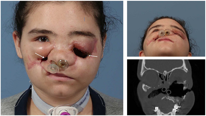 一名19岁女性的术前照片，具有面部受伤史，清创后状况，面部骨折的ORIF，左眼球摘除术。箭头表示皮肤瘘