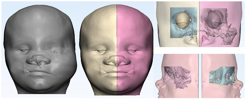 利用患者未患侧的数据和计划的眼部假体的规格说明实现面部对称和创建理想左眼的镜像技术的插图