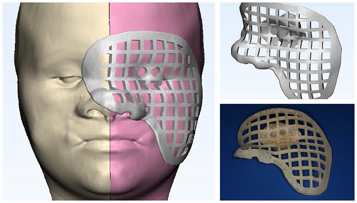 左眼和脸颊手术指南的<a href='https://www.3ddayin.net/soft' target='_blank'><u>3D打印模型</u></a>
