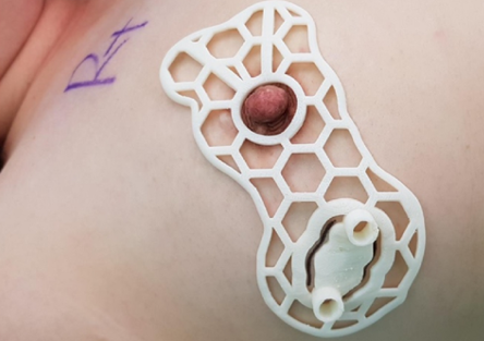 科学家的3D打印指南(如图)被证明比传统的程序优化方法能够节省更多的乳房组织 科学家的3D打印指南(如图)被证明比传统的程序优化方法能够节省更多的乳房组织