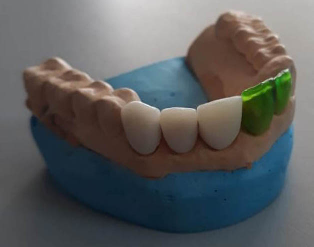 Dentafab 3D 打印的临时牙齿 Dentafab 3D 打印的临时牙齿