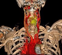 重医二院挑战“生命禁区” 3D打印让恶性颈椎肿瘤患者获新生