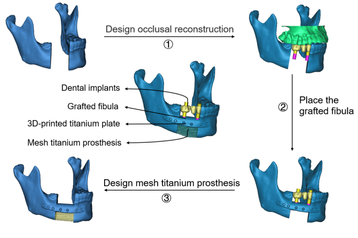 <b>3D打印钛植入物与血管化腓骨移植“组装式”手术重建下颌骨</b>