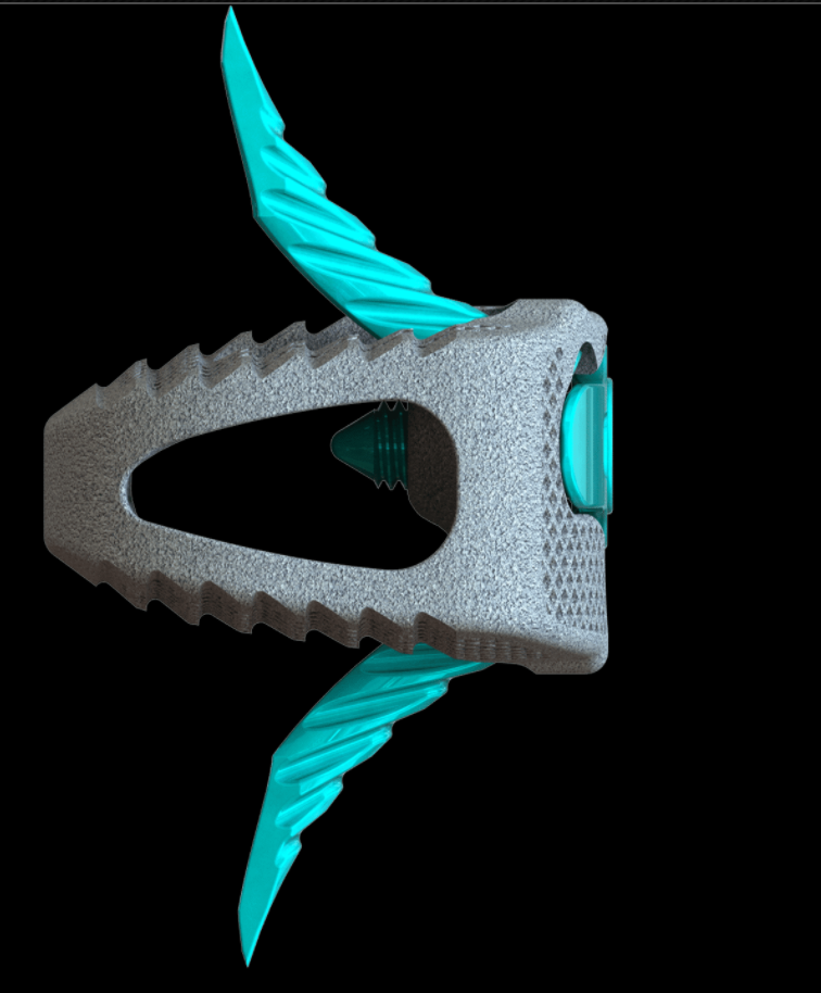Osseus独立前腰椎间融合3D打印骨植入物获FDA批准